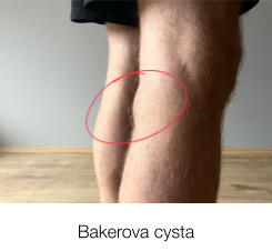 Bakerova cysta
