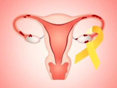 Endometrióza